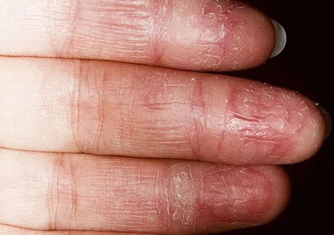 手部慢性湿疹伴真菌感染图片
