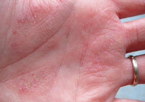 手掌干燥性湿疹初期症状图片