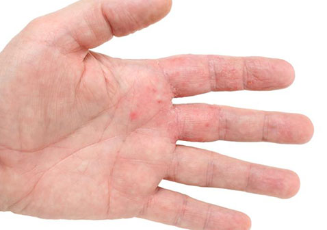 手掌湿疹初期症状图片