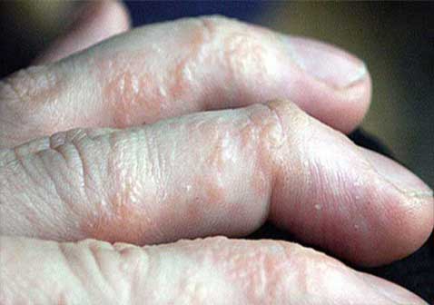 手指慢性湿疹图片