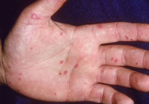儿童9种常见的皮肤病图片6手足口病图片