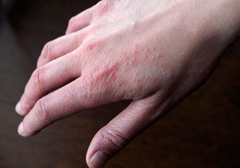 特应性皮炎湿疹的症状图片3