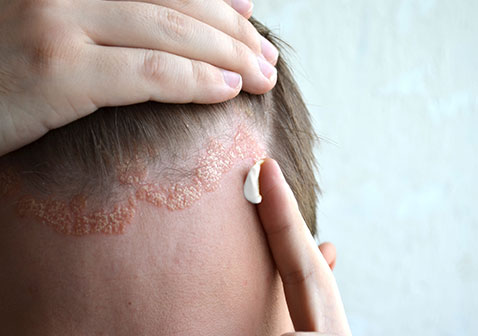 头皮牛皮肤癣是怎么得的治疗图片