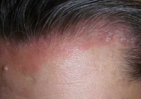 头皮湿疹红斑症状图片