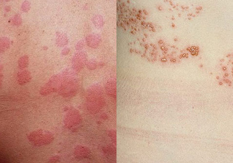 荨麻疹和带状疱疹的区别对比图片
