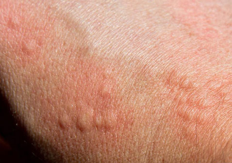 荨麻疹皮肤病图片