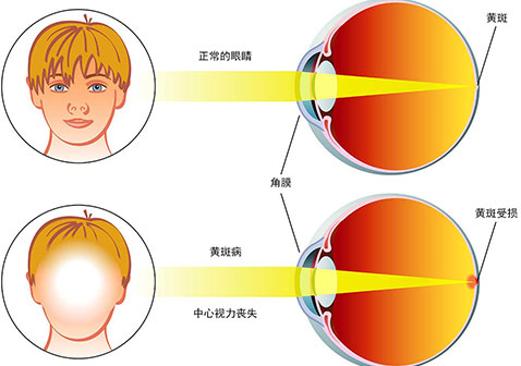 眼底黄斑病怎么治疗及早期症状图片