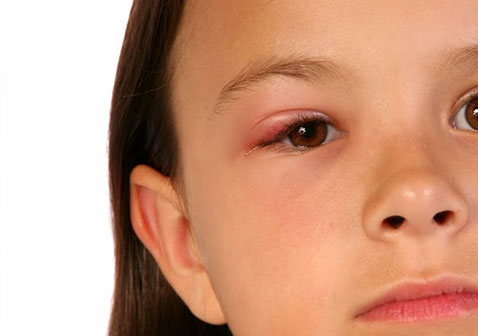 什么是结膜炎红眼病（附图片）