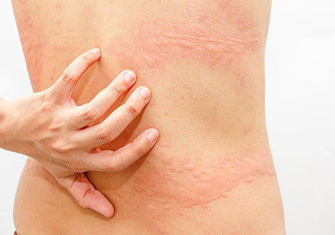 腰部慢性荨麻疹图片