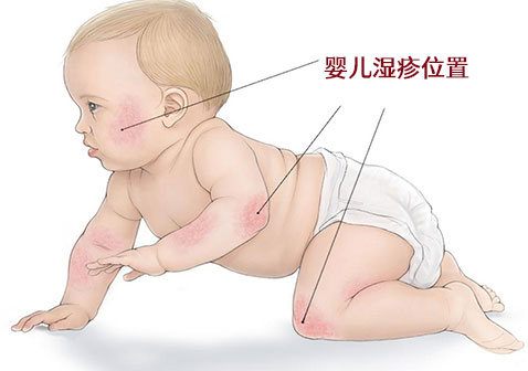 婴儿湿疹位置图片