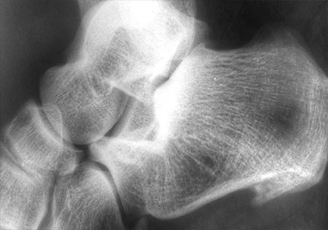 银屑病关节炎脚疼症状x光图片