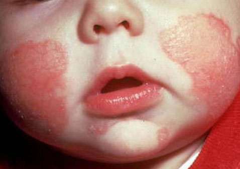 婴儿皮炎湿疹症状图片2
