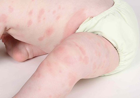婴儿皮炎性湿疹图片