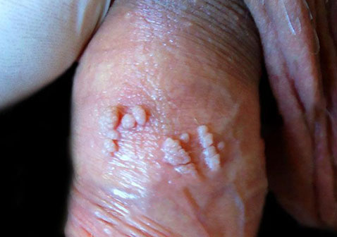 疣的种类甲男性生殖器疣图片