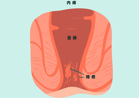 痔疮类型图片内痔