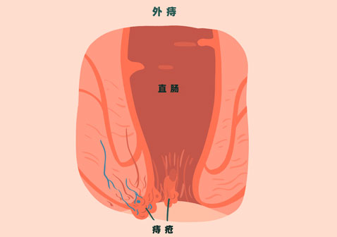 痔疮类型图片外痔