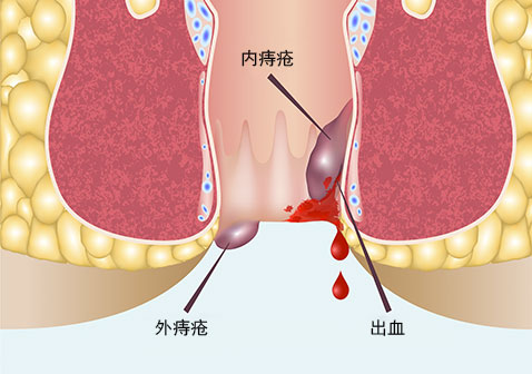 痔疮症状图片