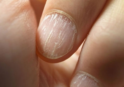 指甲牛皮皮癣图片早期症状
