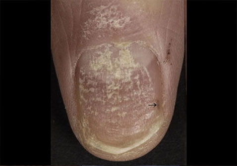 指甲牛皮癣银屑病早期症状图片1