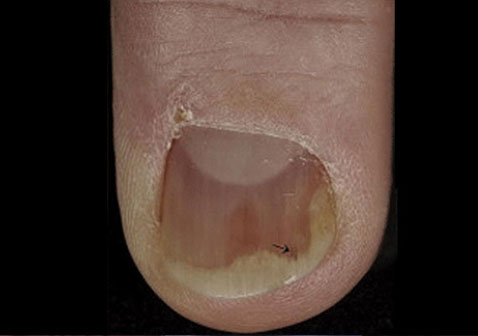 指甲牛皮癣银屑病早期症状图片3