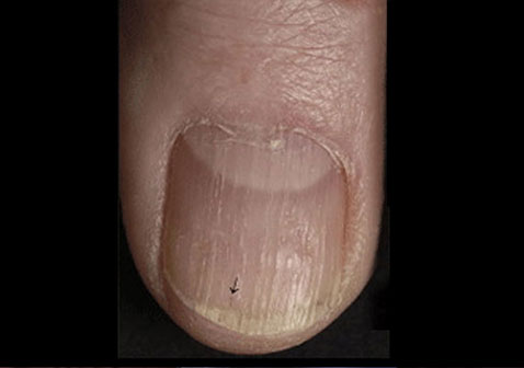 指甲牛皮癣银屑病早期症状图片5