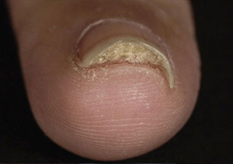 指甲牛皮癣银屑病早期症状图片6