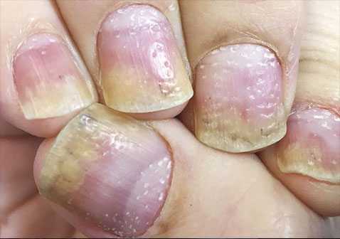 指甲牛皮癣银屑病早期症状图片