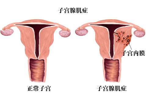 子宫腺肌症图片