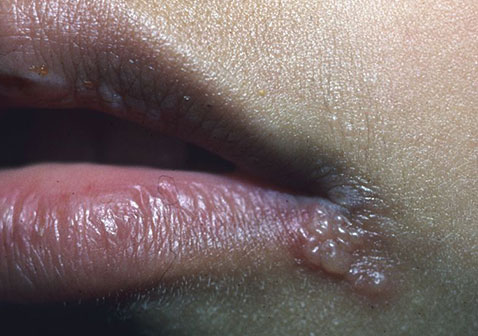 唇疱疹症状图片