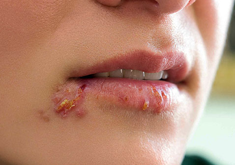 人体100种皮肤病对照图片唇疱疹