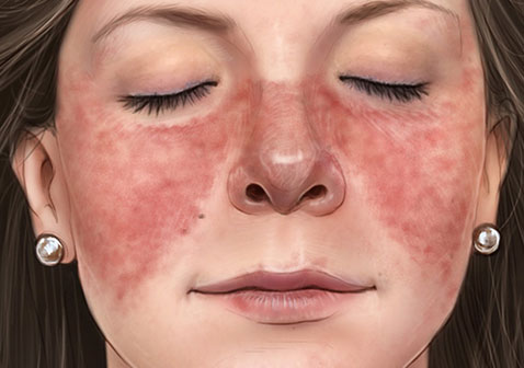 人体100种皮肤病对照图片红斑狼疮