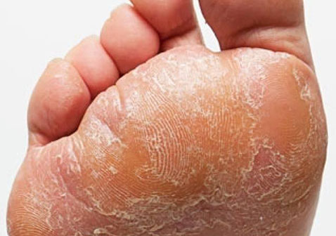 人体100种皮肤病对照图片脚气