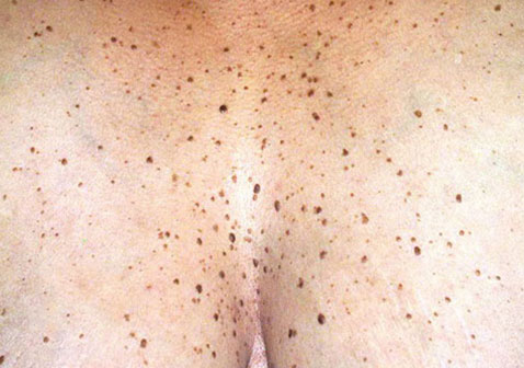 人体100种皮肤病对照图片老年斑