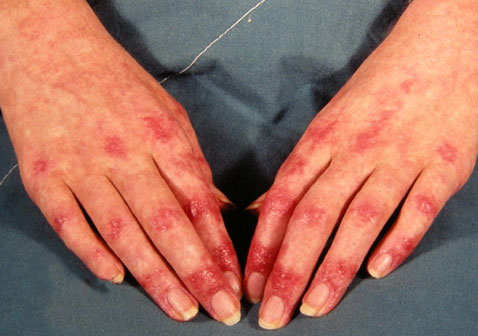 人体100种皮肤病对照图片皮肌炎
