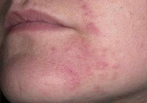 人体100种皮肤病对照图片湿疹