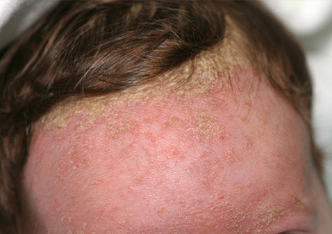 人体100种皮肤病对照图片脂溢性皮炎