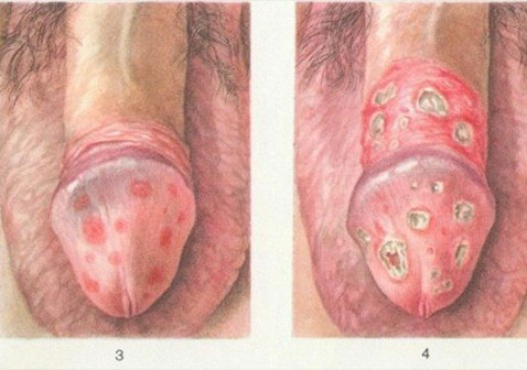 4种龟头炎图片之衣原体龟头炎图片