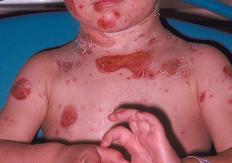 大疱性脓包疮的症状图片