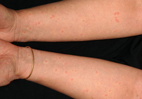 胆碱能性荨麻疹初期症状图片2