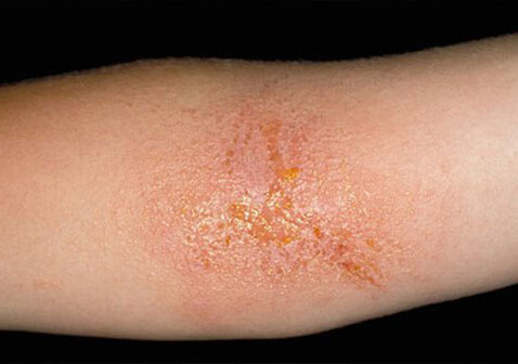 儿童9种常见的皮肤病图片接触性皮炎图片