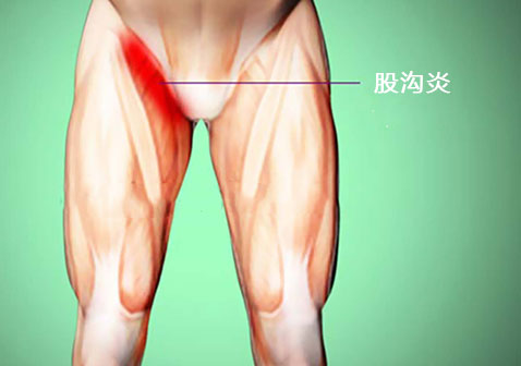 股沟炎症状图片