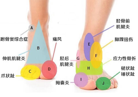 脚背各个部位疼痛部位图解对照表
