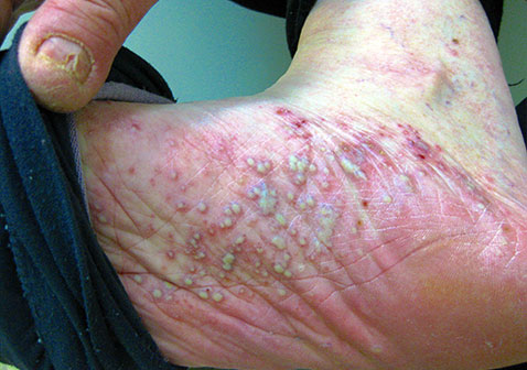脚底脓疱型牛皮肤癣的症状图片