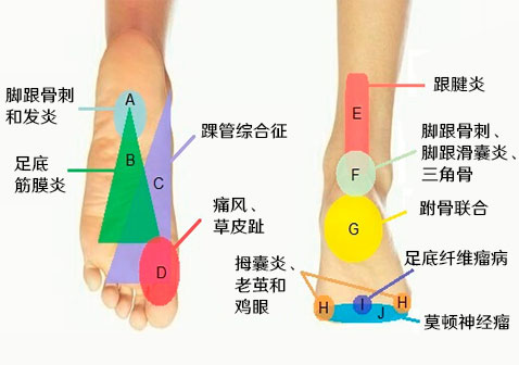 脚底疼痛部位图解