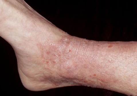 脚踝单纯性苔藓类皮肤病图片