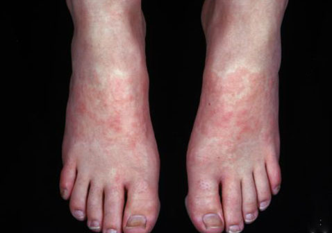 脚上皮肤病识别图片大全接触性皮炎