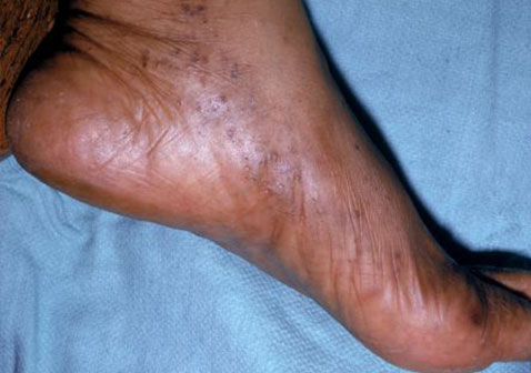 脚上皮肤病识别图片大全水泡性湿疹