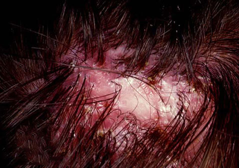 金色葡萄球菌皮肤病图片脱发性毛囊炎