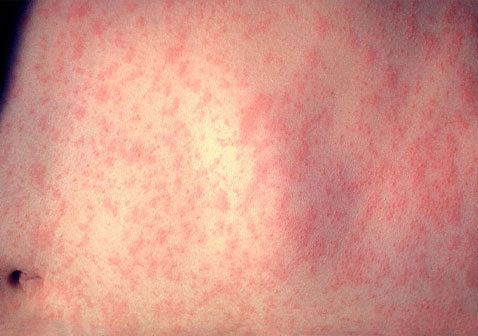 麻疹图片和症状图片红色斑丘疹
