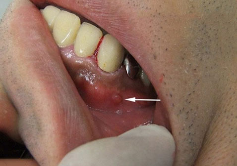 慢性牙周炎图片和症状图片